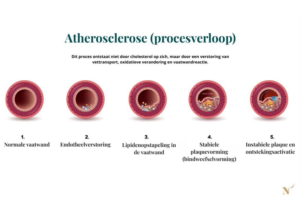 Schema van atherosclerose procesverloop met endotheelverstoring, lipidenopstapeling en plaquevorming